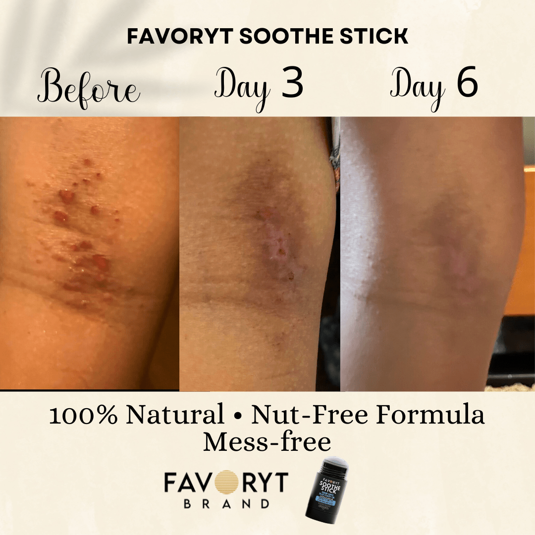 Soothe Stick Skin Balm Stick for Eczema and Dry, Cracked Skin, Soothing effect for itch and irritation - FAVORYT BRAND