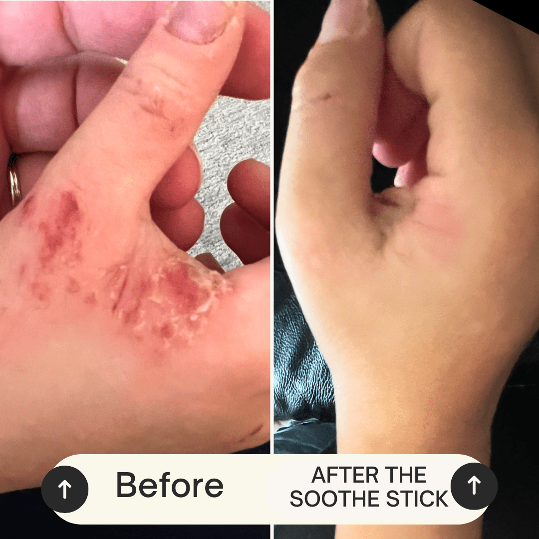 Soothe Stick Skin Balm Stick for Eczema and Dry, Cracked Skin, Soothing effect for itch and irritation - FAVORYT BRAND